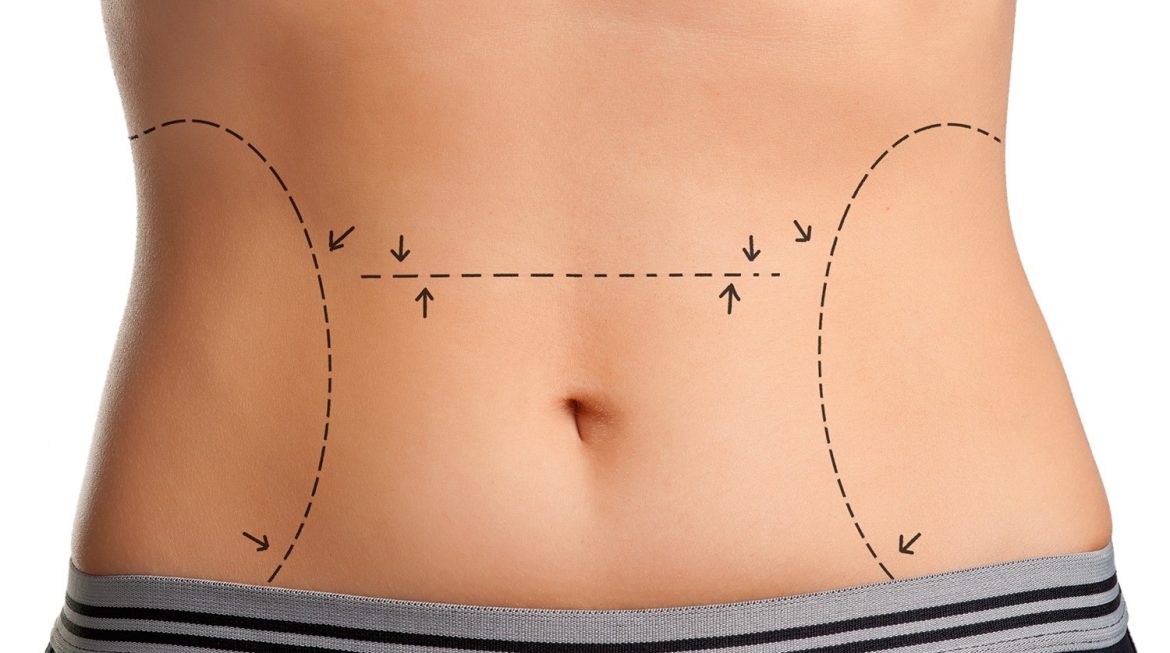 Abdominoplastia na cicatriz da cesárea