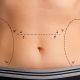 Abdominoplastia na cicatriz da cesárea