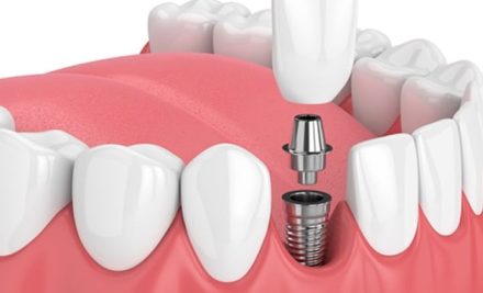 Implante dentário convencional ou guiado?