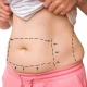 Qual a indicação para lipoaspiração ou abdominoplastia?