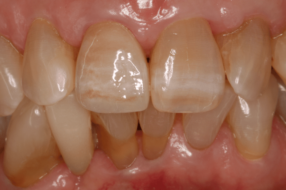 Manchas brancas nos dentes