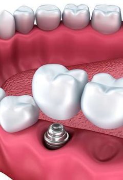 Pontes vs implantes dentários
