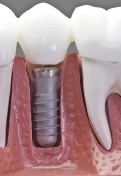 Implante imediato e carga imediata: quais as diferenças?