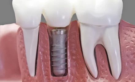 Implante imediato e carga imediata: quais as diferenças?