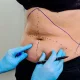 Dermolipectomia abdominal: o que é essa técnica?