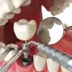 Implantes dentários: por que investir?