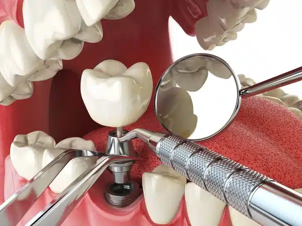 Implantes dentários: por que investir?