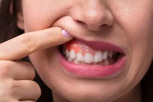 Coçando: Causas e Tratamento na Odontologia