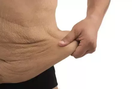 Excesso de pele após a perda de peso