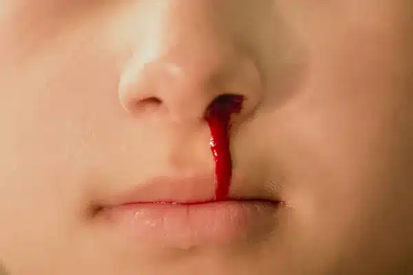 Sangramento no nariz: precisa de intervenção médica?
