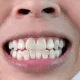 Manchas brancas nos dentes: o que significam?