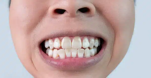 Manchas brancas nos dentes: o que significam?
