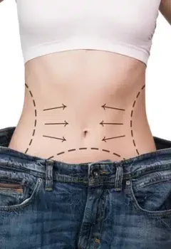 Lifting Corporal Inferior para a flacidez pós-perda de peso