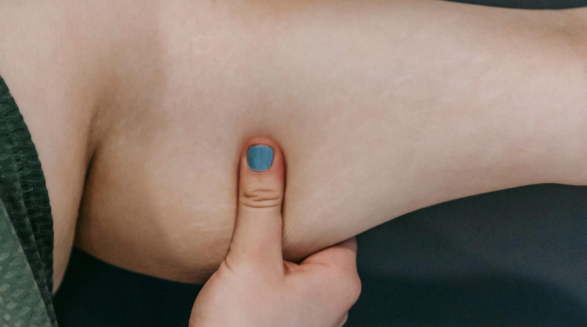 Braquioplastia e o tratamento da flacidez em pacientes pós-bariátrica