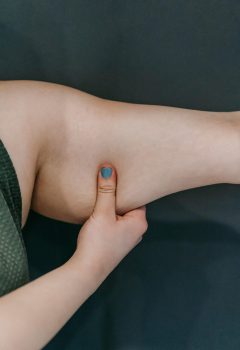 Braquioplastia e o tratamento da flacidez em pacientes pós-bariátrica