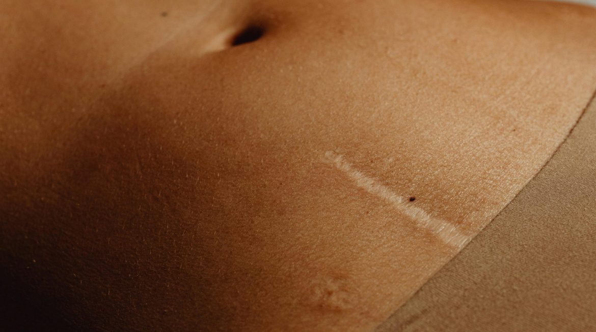 Os desafios e os benefícios das cirurgias para reconstrução corporal no pós-bariátrica