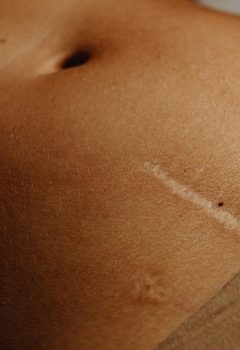 Os desafios e os benefícios das cirurgias para reconstrução corporal no pós-bariátrica